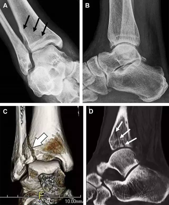 常见的八种骨折,容易漏诊的肩关节骨折