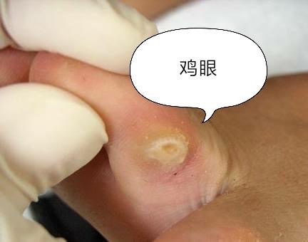 脚上长鸡眼是皮肤病吗,脚上起的是鸡眼还是疣