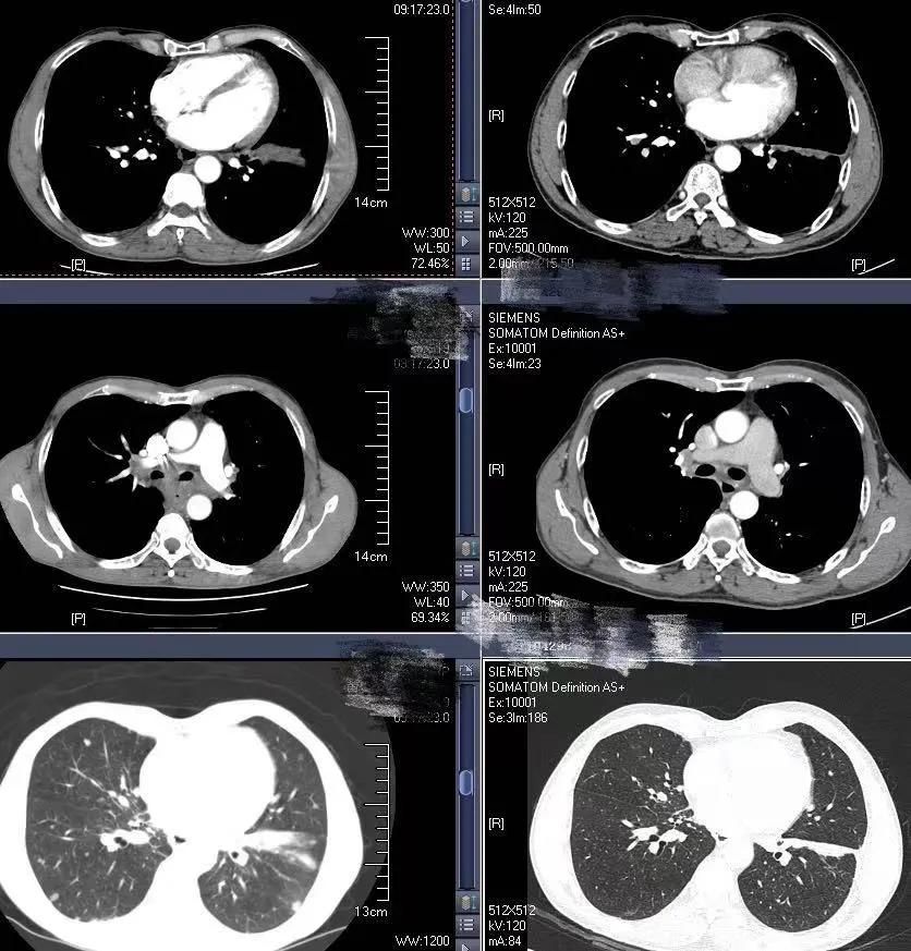 腰痛与肺癌有关吗,腰痛的厉害是得了肾癌吗