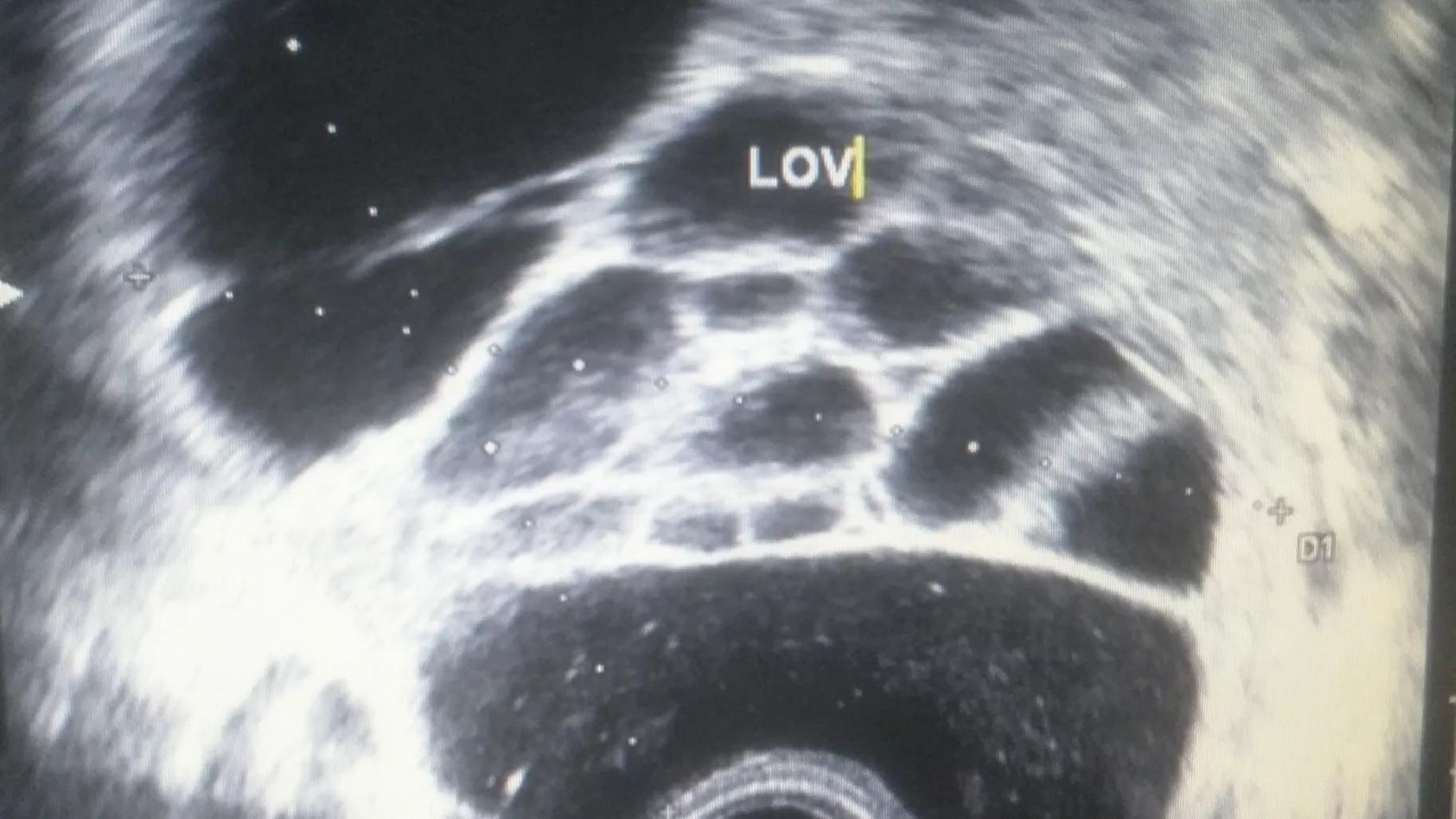 29岁的抗癌之路,26岁胃癌晚期死亡