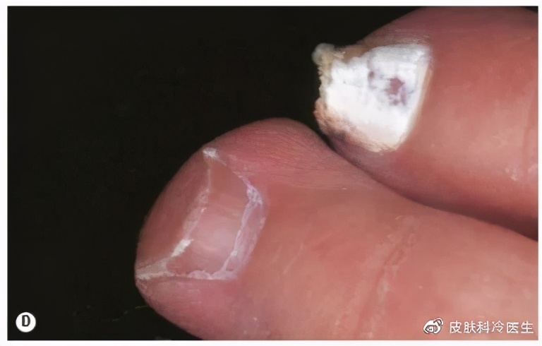 灰指甲就是灰色的吗,灰指甲的颜色是灰的吗