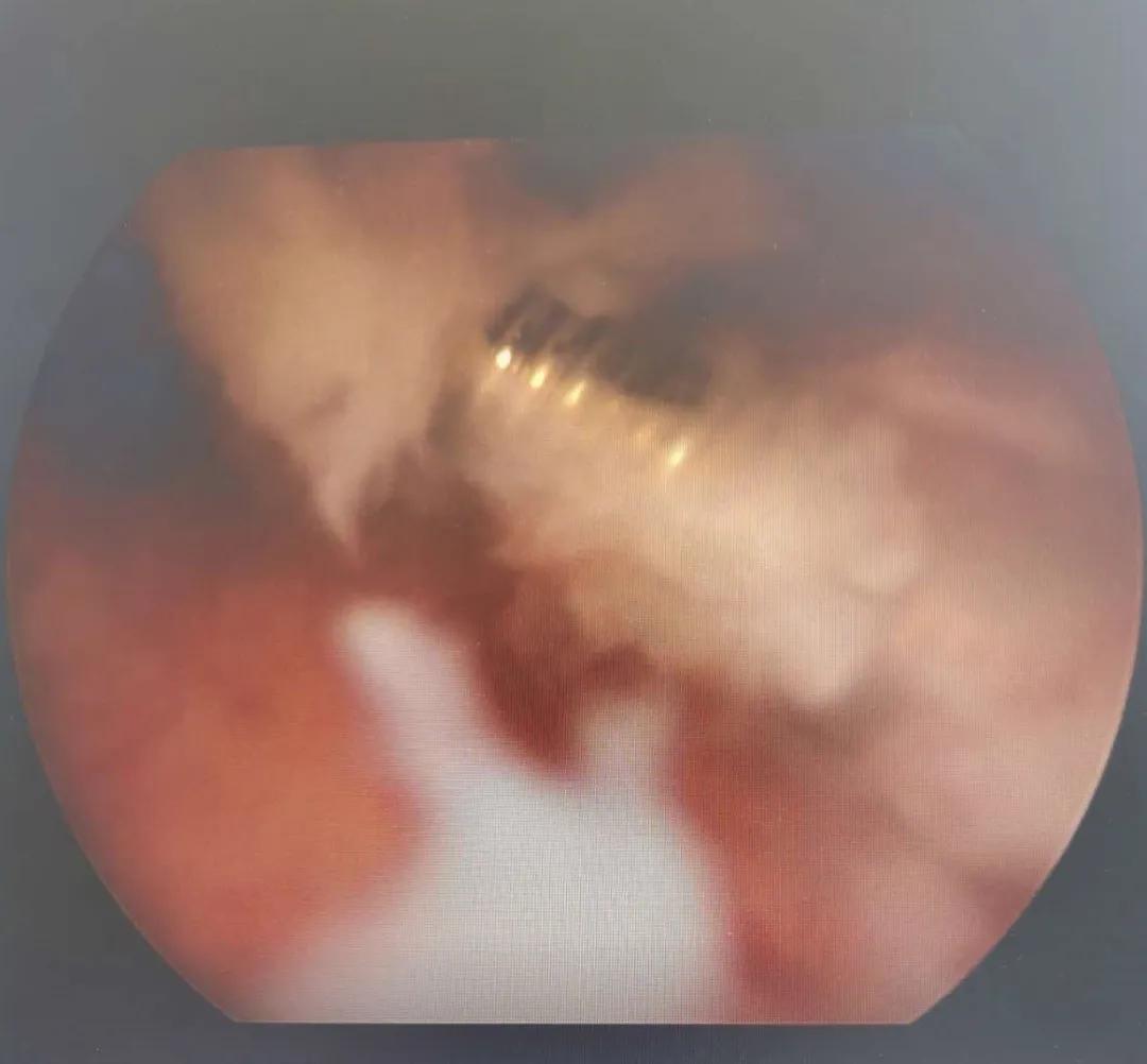 亳州市妇幼保健院妇产科开展宫腔镜手术为患者排忧解难