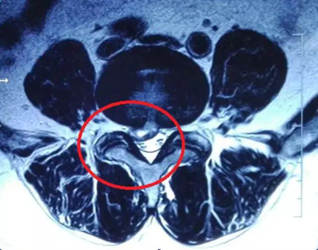 有节育环能否做胸腔核磁共振,有节育环能否做膝盖核磁共振