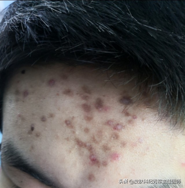 喜辽妥软膏可以祛除红色痘印吗,疤克可以去除脸上的红色痘印吗