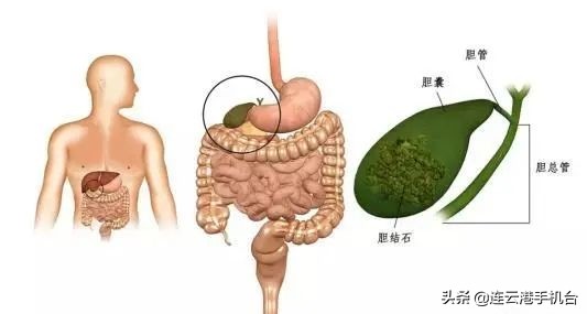 吃什么容易诱发急性胆囊炎,吃什么会诱发急性胆囊炎