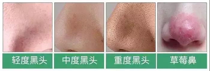 黑头闭口连根拔起,黑头粉刺连根拔起留坑