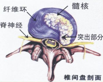 腰椎膨出和突出还有脱出图片,腰椎间盘突出脱出膨出区别