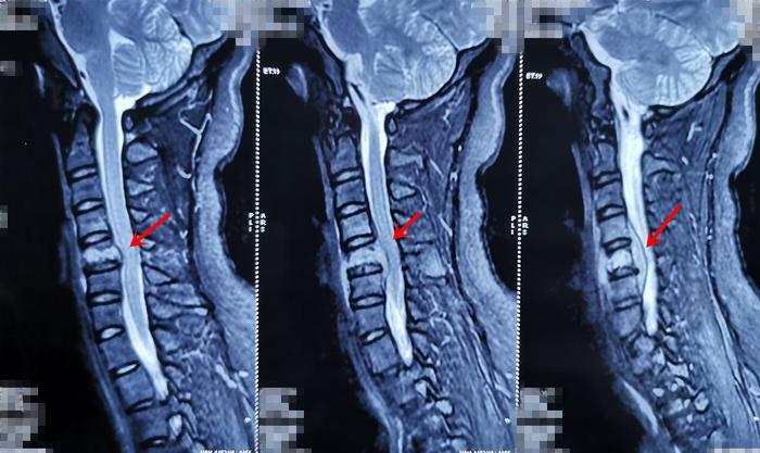 因颈背部疼痛、上臂抽疼，检查出颈5椎体结核