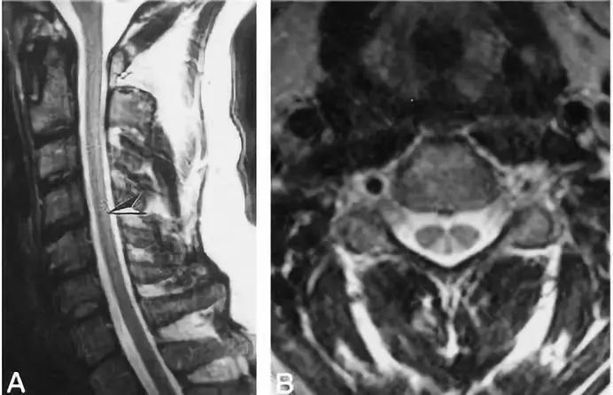 脊髓病变案例图文问诊,脊髓病变视频