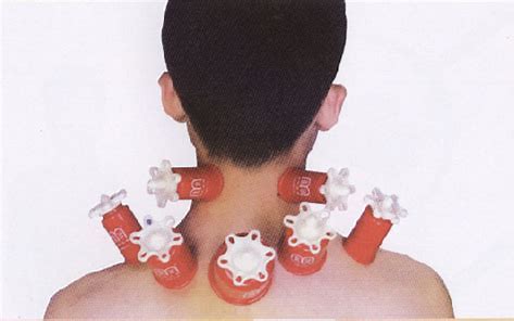 拔罐需要注意什么事项,肚子拔罐方法及注意事项