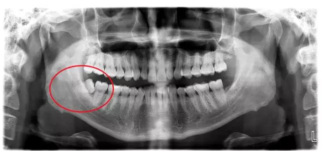 最简单的智齿拔除多少钱一颗,拔除智齿一般多少钱一颗