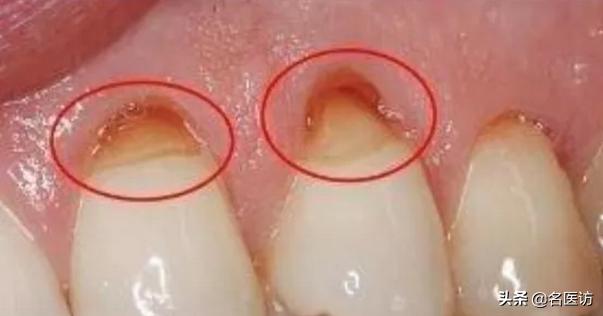 牙齿吃雪糕敏感怎么办,牙齿吃冰的就特别敏感怎么办