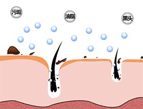 黑头真的没办法洗掉吗,黑头和闭口粉刺清理方法