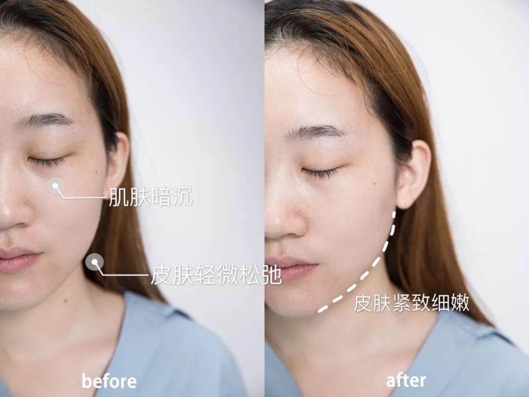 大饼脸用什么减肥方法,减肥圆脸变v字脸效果好吗