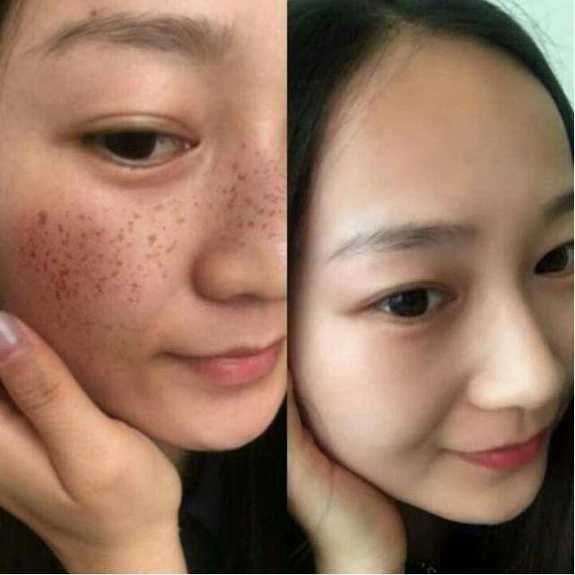 ps去雀斑最有效的小妙招,ps祛雀斑的最佳方法