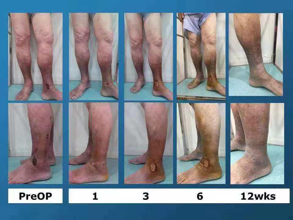 得了静脉曲张怎么办在家就能缓解 (得了静脉曲张这种病该怎么调养)