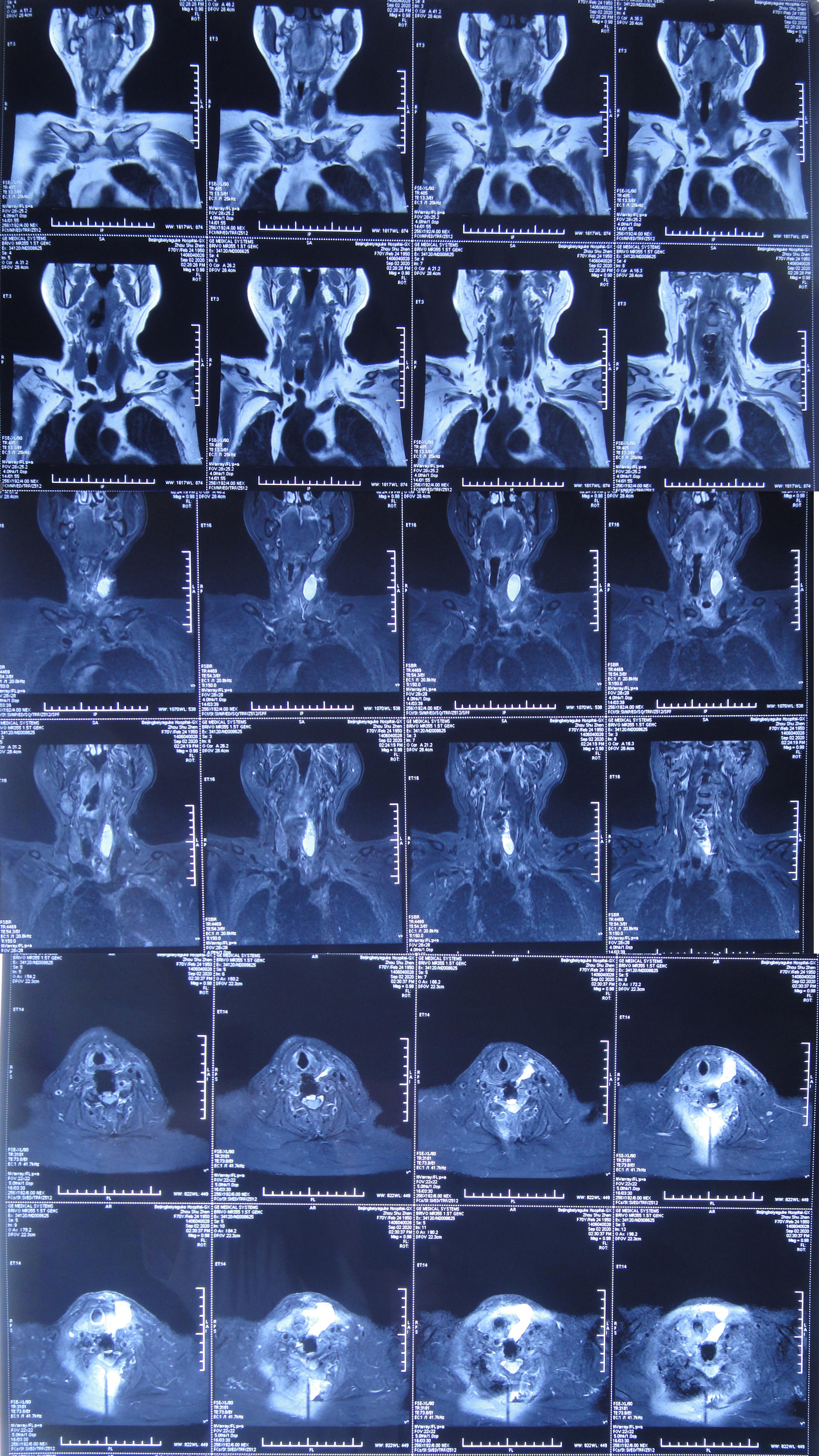 颈椎术后脑脊液漏取什么体位,脊髓型颈椎病手术后植骨愈合时间
