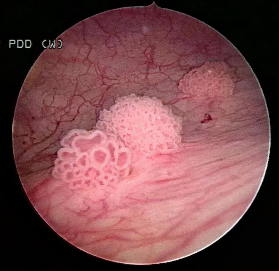 小便刺痛并带血是什么原因,妇科小便带血是什么原因