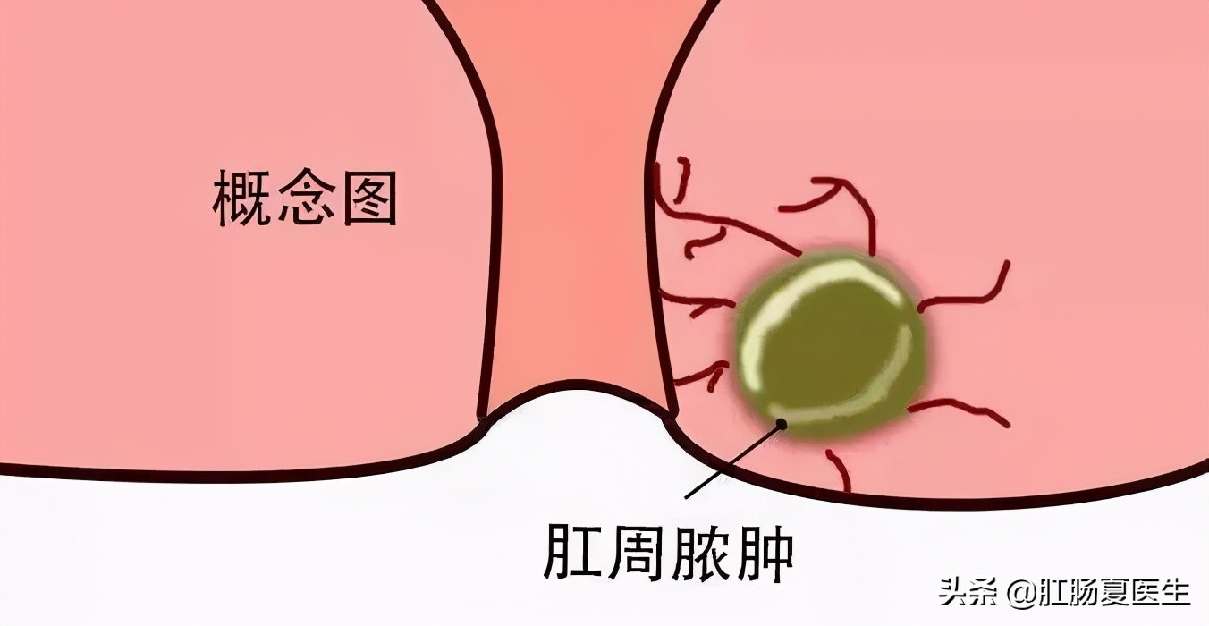 肛周脓肿是什么毛病严重吗,肛周脓肿男生大哭