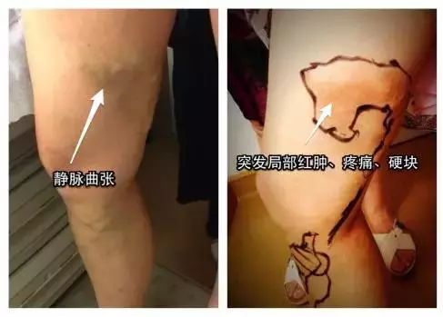 下肢静脉曲张血栓性静脉炎的症状,静脉曲张怎么会引起血栓性静脉炎