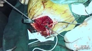 治疗肩锁关节脱位，有最好的方法吗？