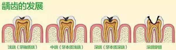 北京精德口腔详解要不要洗牙,精德口腔北京