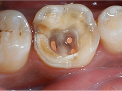 根管治疗可怕,根管治疗很恐怖吗