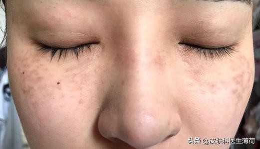 脸上有斑是做冷冻还是激光,黄褐斑用激光祛好还是吃中药