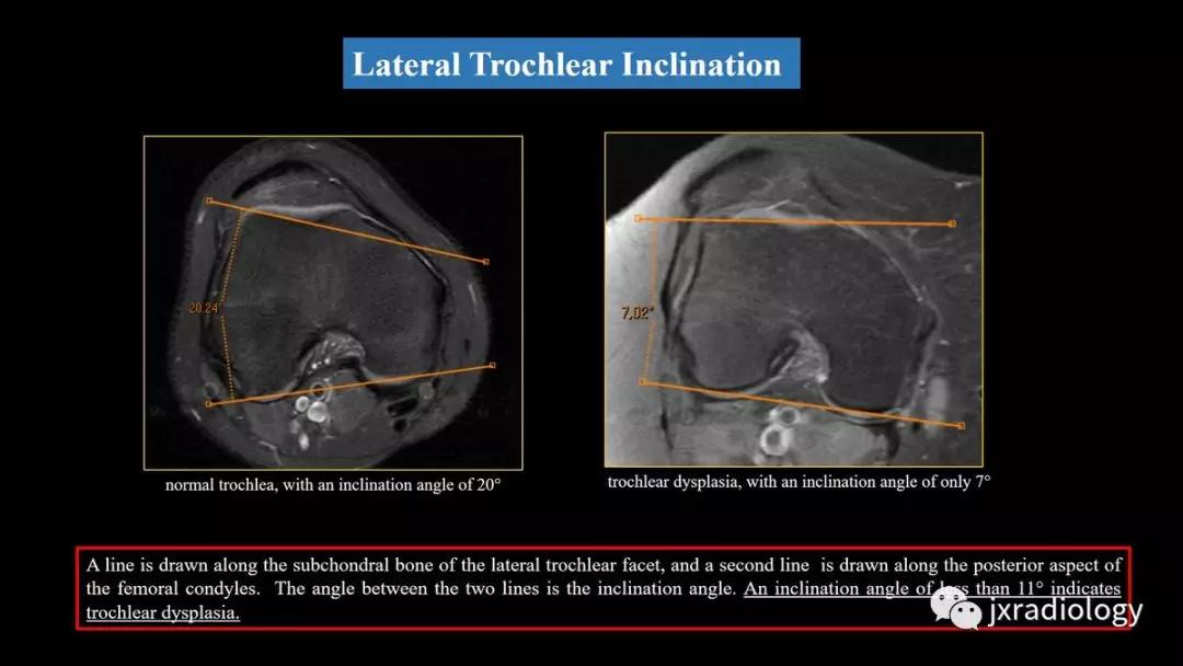 髌股关节失常磁共振看什么,髌股关节混乱的影像评估