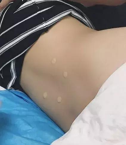 非药物性水针镇痛,缓解产程中腰酸腰痛的良方