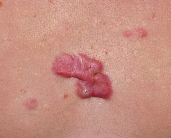 疤痕疙瘩可以去除吗？如何去除？