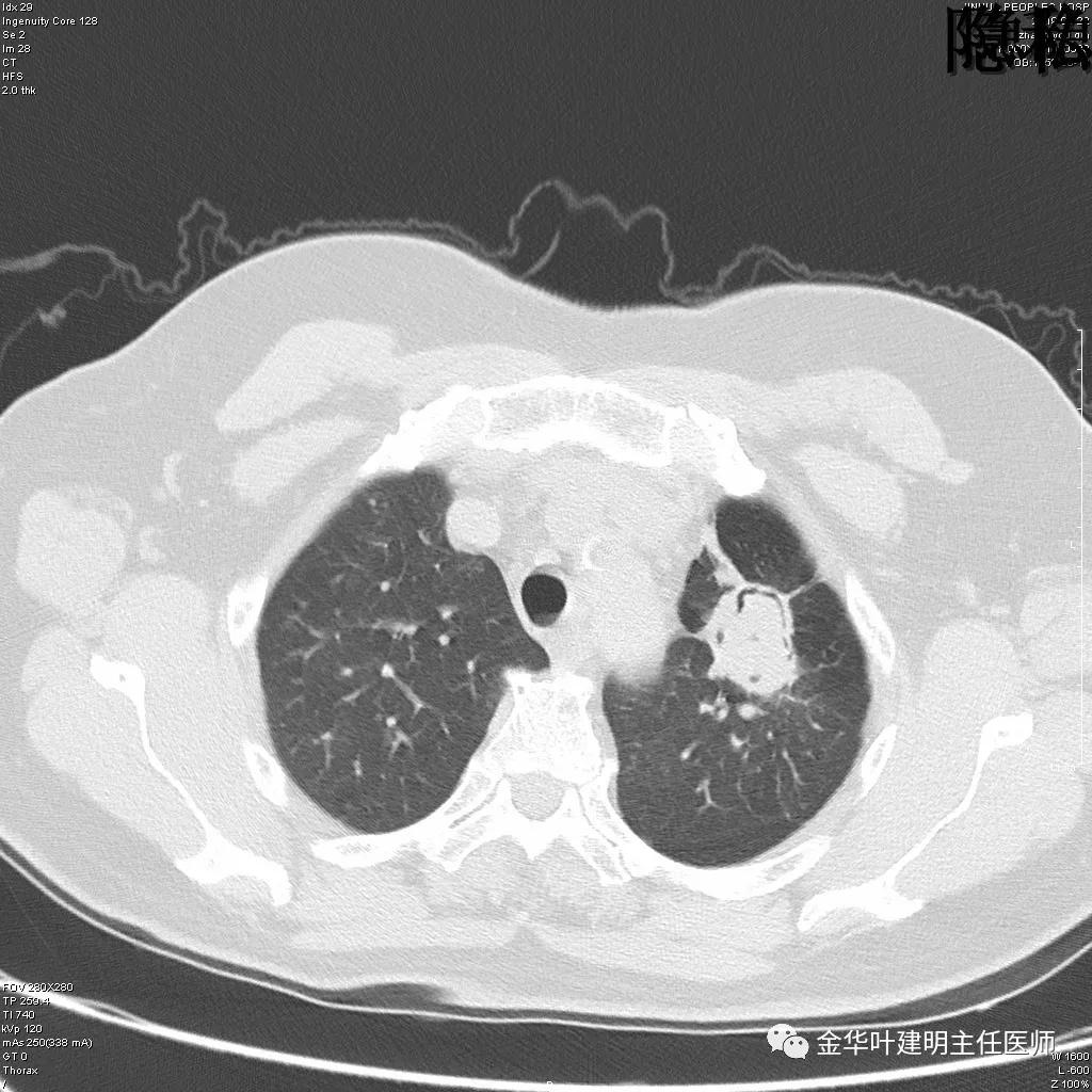 左肺下叶恶性病变,左肺上叶和下叶都有血管畸形
