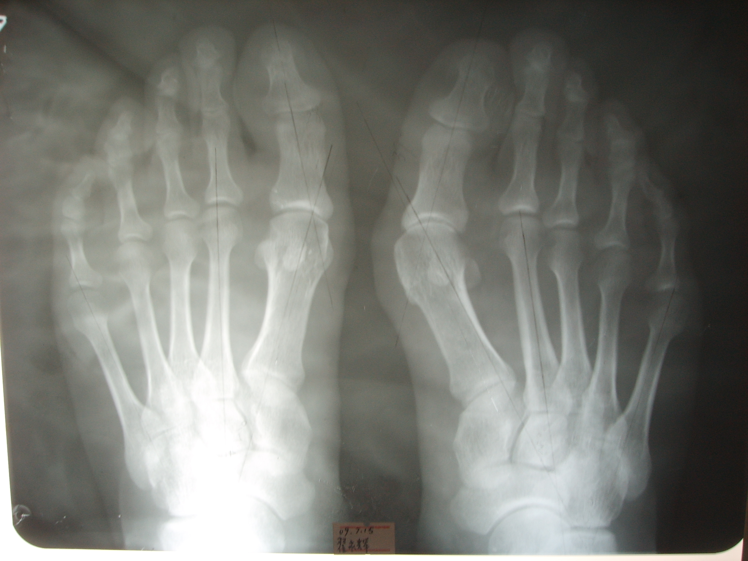 20岁男拇外翻,年轻小伙子拇外翻好大