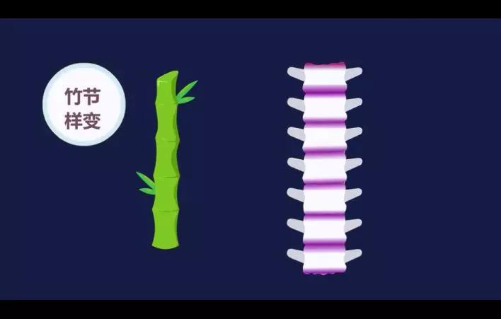 强直性脊柱炎可以做广播体操吗,一起来做广播操