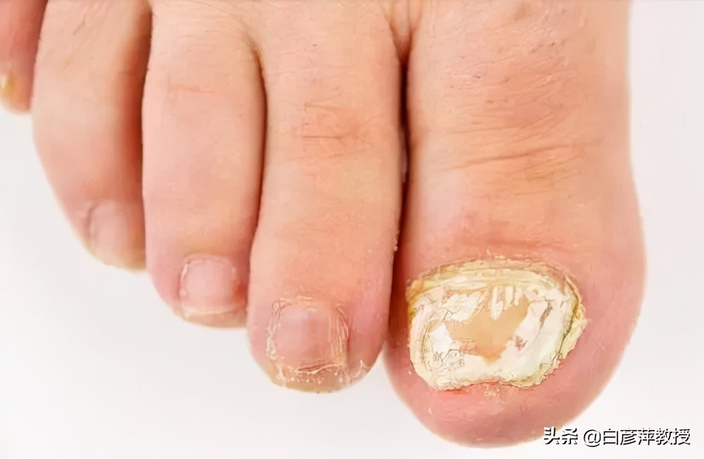 灰指甲是真菌怕晒吗,灰指甲一定是灰色的吗