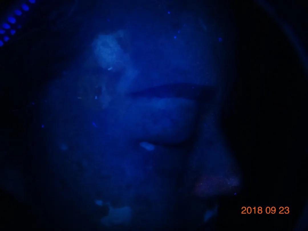 一位散发型白癜风患者的自白：坚持治疗能痊愈，千万别放弃自己