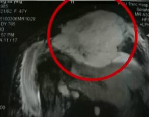 肩周炎自愈辟谣,肩膀疼怎么会引起肩周炎