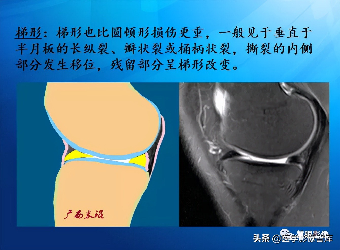 膝关节半月板损伤的解剖结构图,半月板mri解剖图解