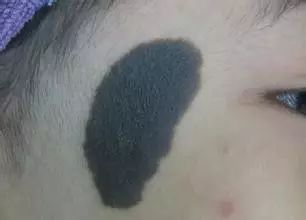 婴儿胎记激光治疗,新生儿胎记最佳治疗