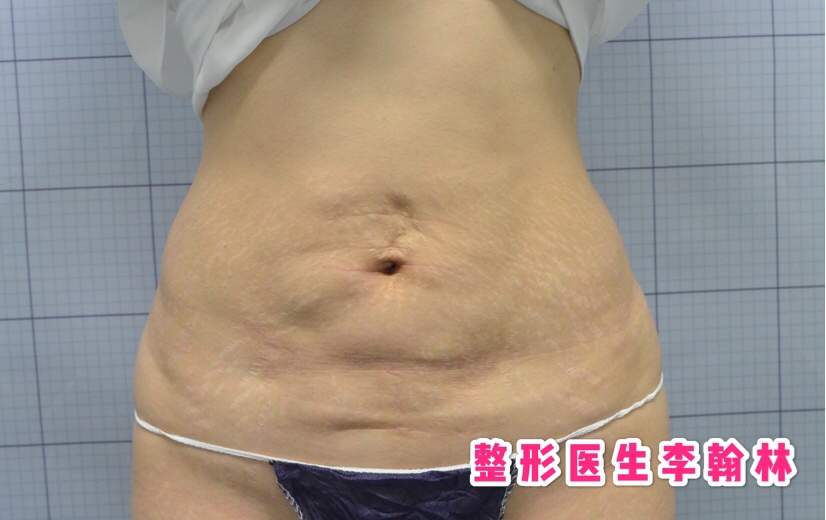 双下巴吸脂手术的危害,腹部吸脂手术有什么危害