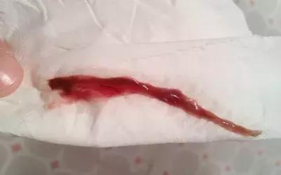 *裤内**总是有“东西”，怎么办？