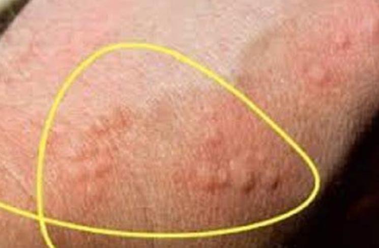 葡萄糖酸钙只有静注才能抗过敏么,除了补钙还要补氨糖软骨素