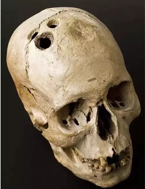 电击、开颅、切脑,为了治病精神病患者受过多少罪