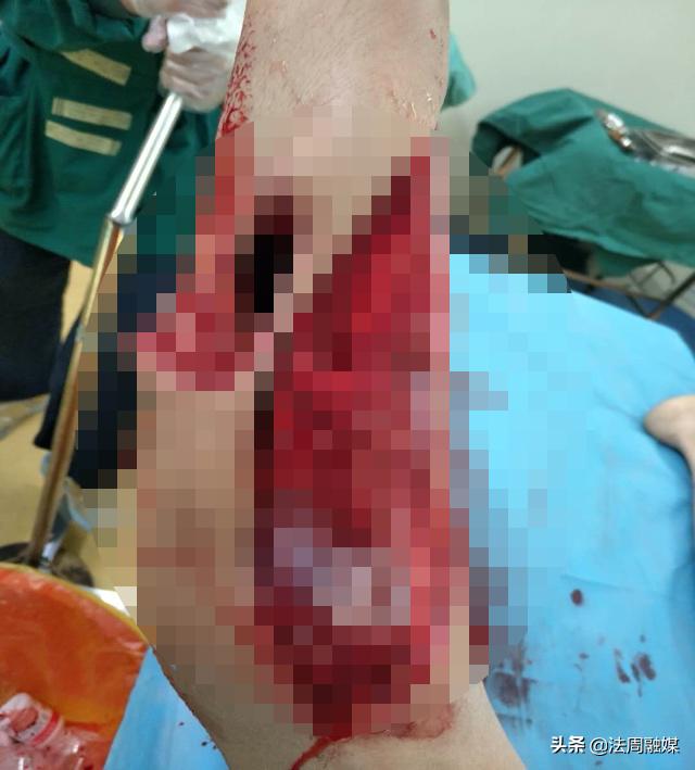 交通事故小腿胫骨骨折做手术,常德市第一中医医院骨伤科