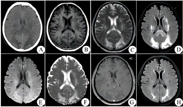 车祸脑外伤后综合征,车祸导致低钾血症