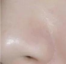 听说你毛孔大到可以放芝麻，该怎么办？