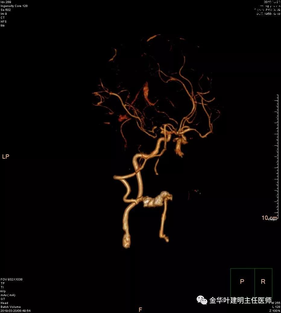左肺下叶恶性病变,左肺上叶和下叶都有血管畸形