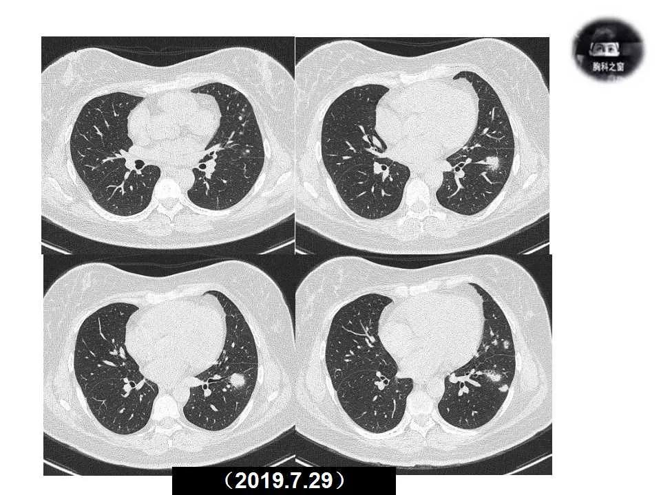 双肺多发结节是肺癌的征兆吗,双肺多发结节灶