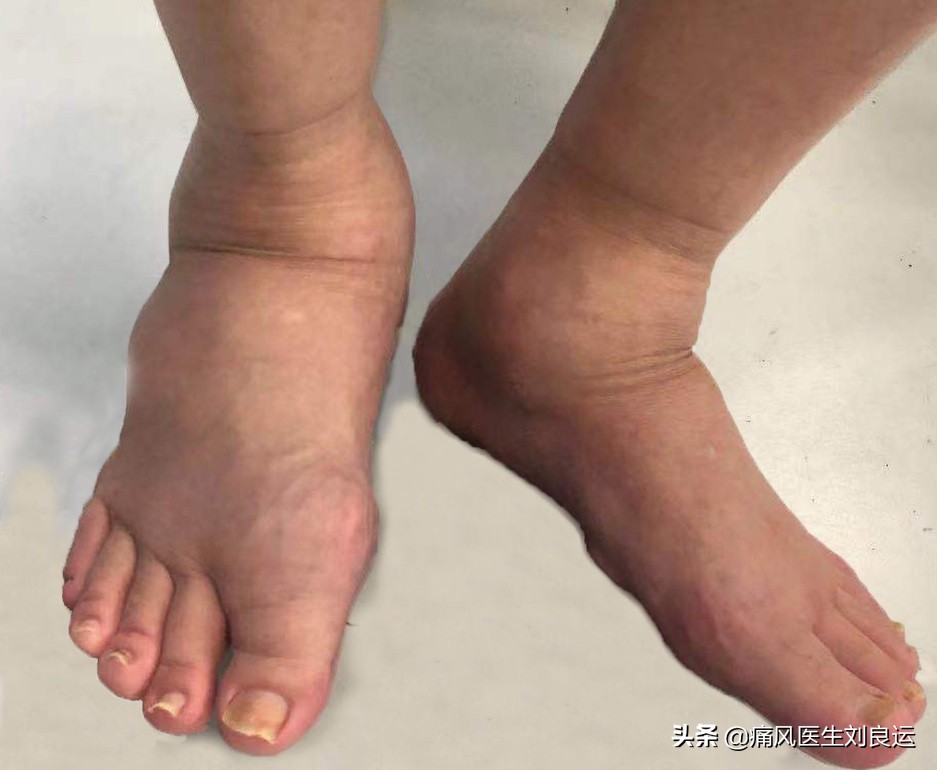 尿酸高吃什么药可降尿酸不伤肝,痛风吃什么降尿酸的药不伤肝