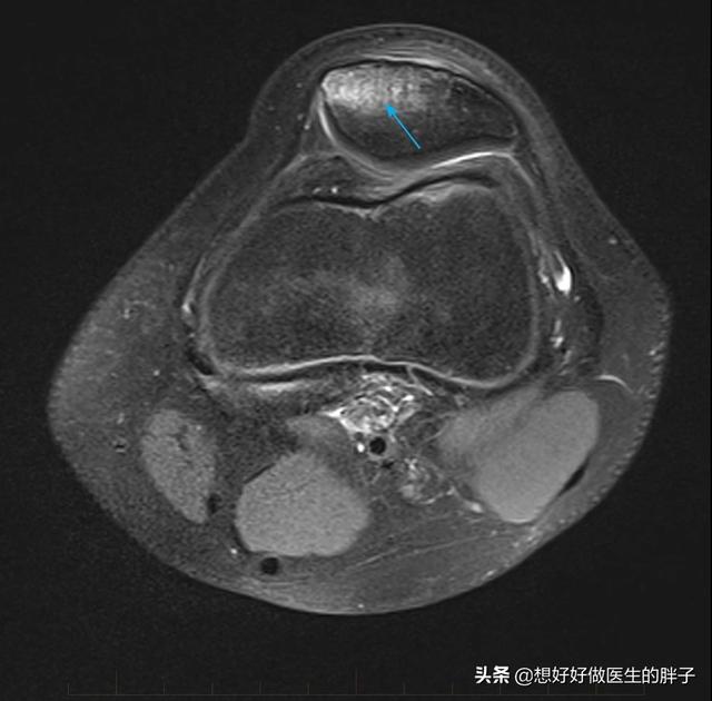 膝盖磕到了没肿但痛,膝盖磕了一下髌腱损伤怎么治